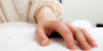 Acupuncture Carpal Tunnel Cure Mystery Solved